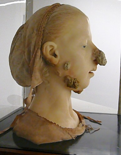 1865 wax model of woman with tubercular scrofula