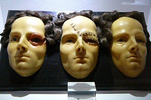 1842 wax model of woman with ectropion of the eyelids