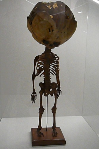 Skeleton of child with hydrocephalus