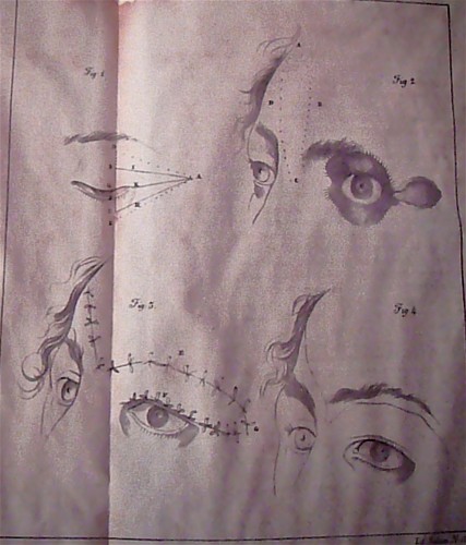 Illustration published in 1843 of a surgical blepharoplasty